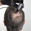 stem cell hair growth factors equipment