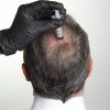stem cell hair growth factors equipment