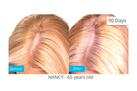 Nancy Before After Treatment